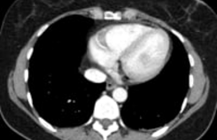 CT abdomen transversaal