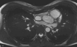 Video. Magnetic resonance imaging van een patiënt met pectus excavatum, waarbij een disfunctie van zowel de rechter als linker harthelft zichtbaar is.