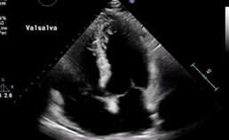 Transthoracale apicale vierkameropname van de patiënt uit de casus waarbij er zowel met als zonder Valsalva-manoeuvre oversteek van contrast is van de rechterkant van het hart (links) naar de linkerkant van het hart (rechts).