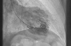 Linkerventrikelangiogram van een takotsubocardiomyopathie