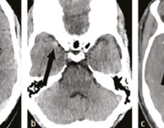 Patent foramen ovale (PFO) en herseninfarct