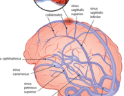 Cerebrale veneuze sinustrombose