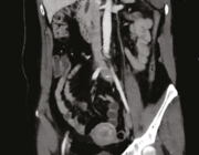 Embolie uit arteria lienalis-aneurysma als oorzaak van miltinfarct