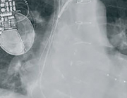 Left ventricular assist device (LVAD)therapie in eindstadium hartfalen