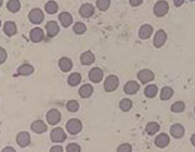 Gelijktijdige presentatie van microscopische polyangiitis en B-cel chronische lymfatische leukemie